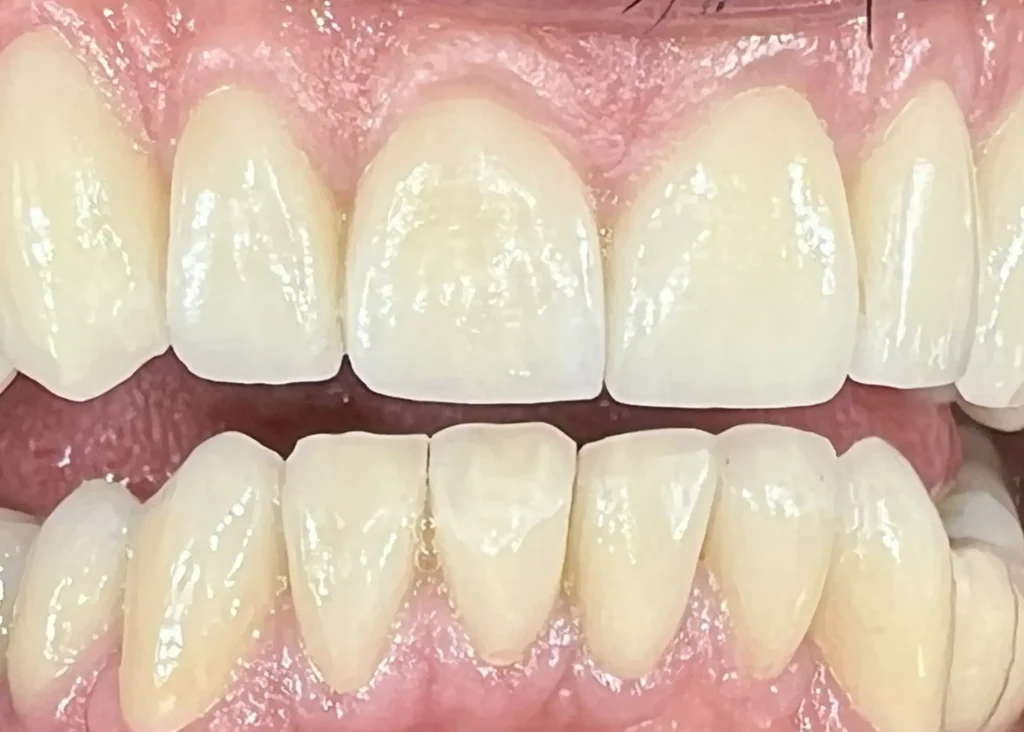 El después de un tratamiento de carillas dentales en Ferrol