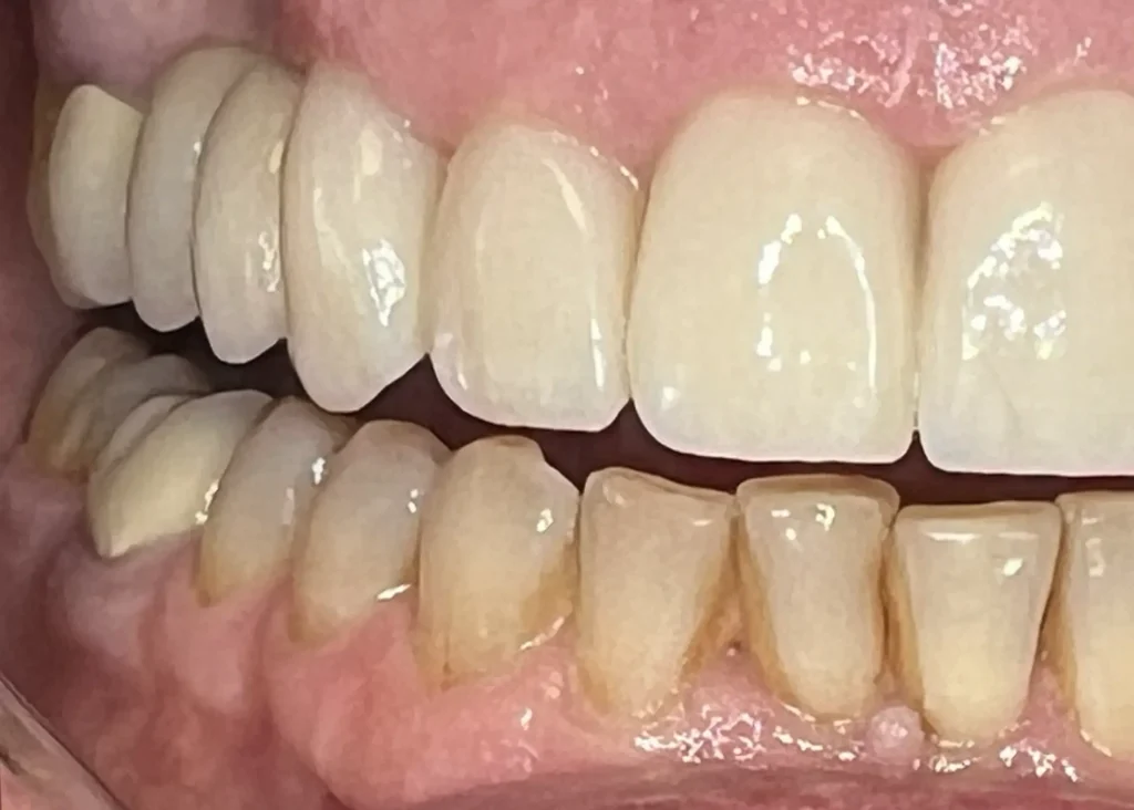 Resultado final de de un tratamiento de implantes dentales en Clínica Dental Patricia Aneiros
