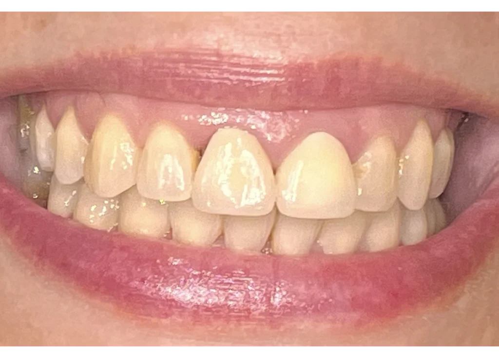clinica-dental-patricia-aneiros-carillas-casos-antes-95