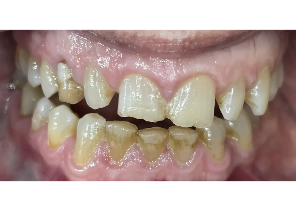 clinica-dental-patricia-aneiros-carillas-casos-antes-96