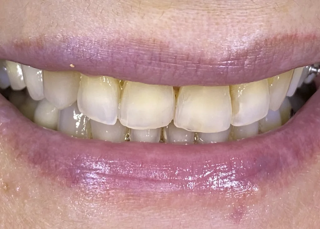 clinica-dental-patricia-aneiros-carillas-casos-antes-97