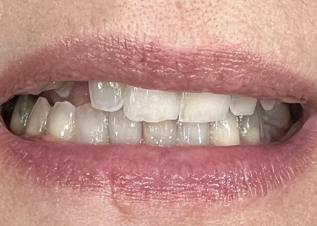clinica-dental-patricia-aneiros-carillas-casos-antes-98