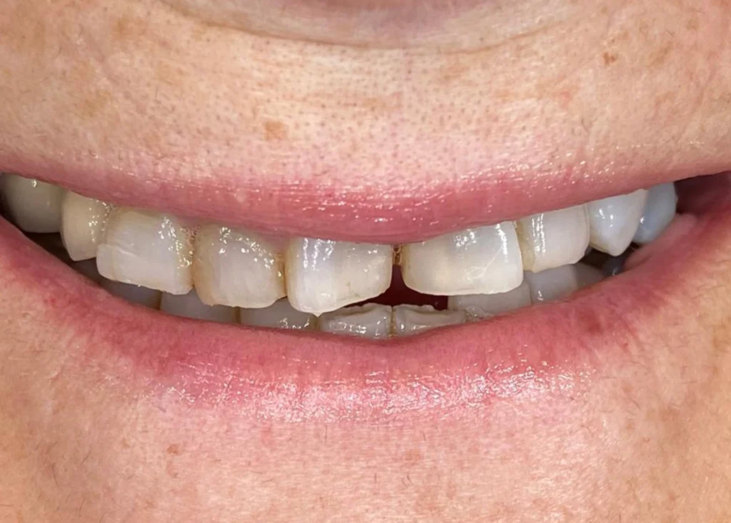 clinica-dental-patricia-aneiros-carillas-casos-antes-99