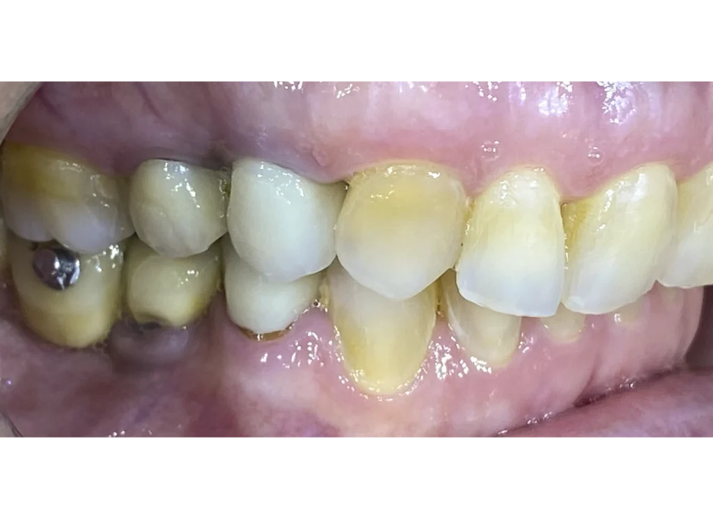 clinica-dental-patricia-aneiros-carillas-casos-antes-lateral-97