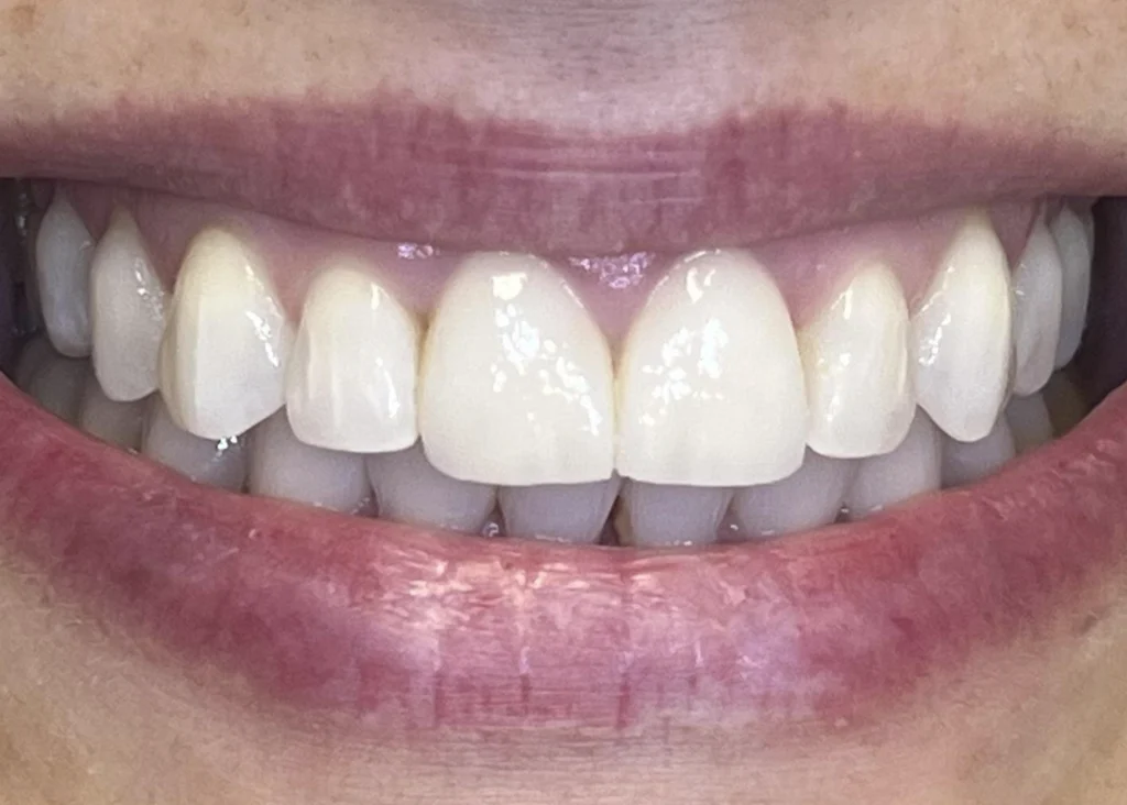 clinica-dental-patricia-aneiros-carillas-casos-despues-95