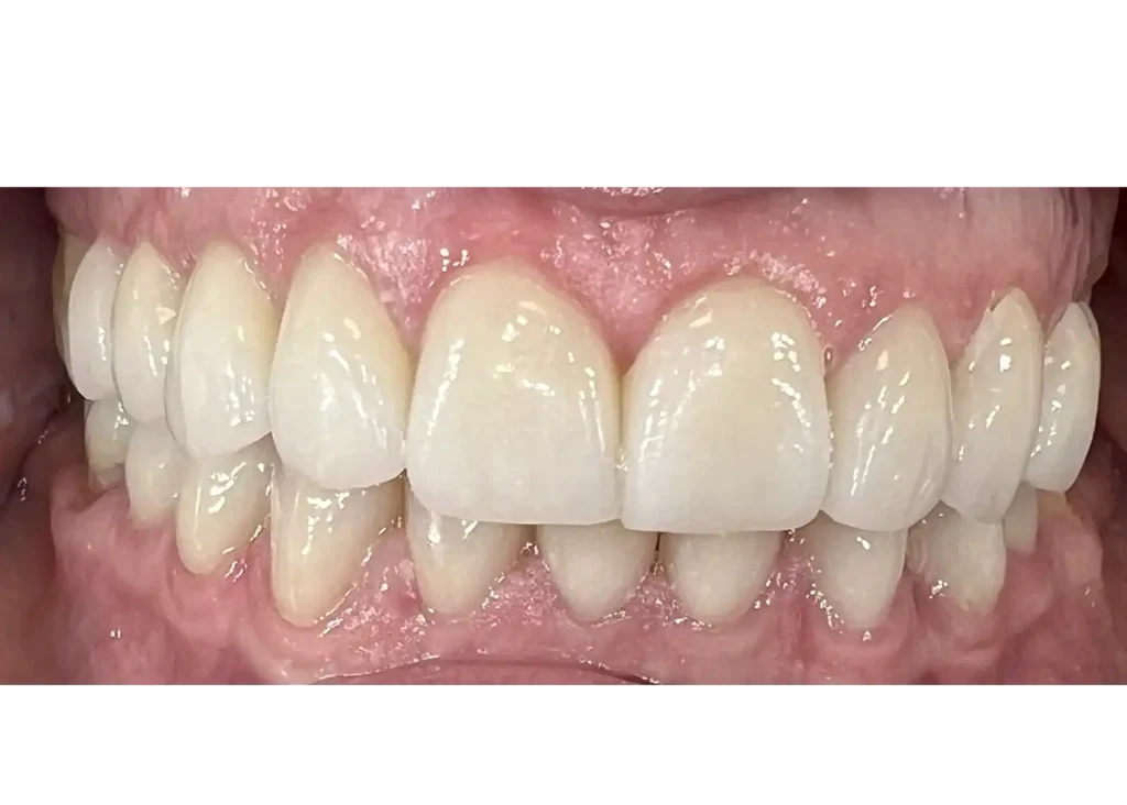 clinica-dental-patricia-aneiros-carillas-casos-despues-96