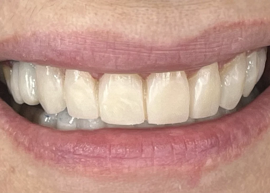 clinica-dental-patricia-aneiros-carillas-casos-despues-97webp