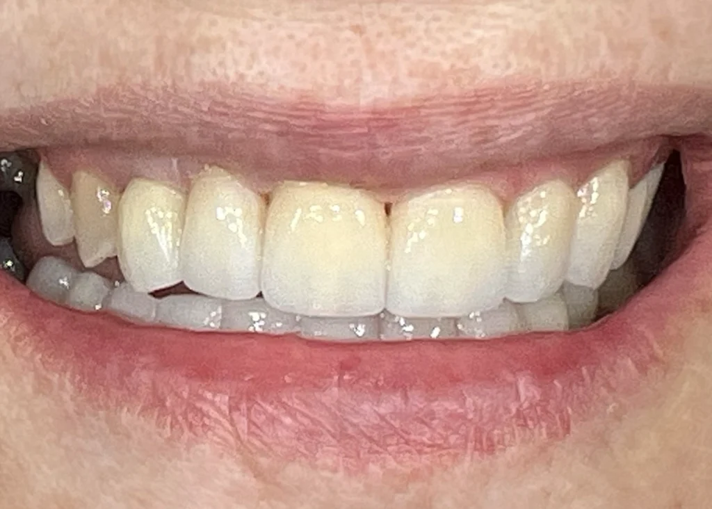clinica-dental-patricia-aneiros-carillas-casos-despues-98