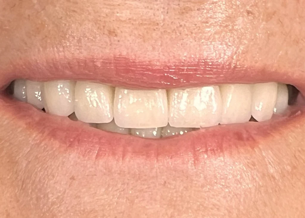 clinica-dental-patricia-aneiros-carillas-casos-despues-99