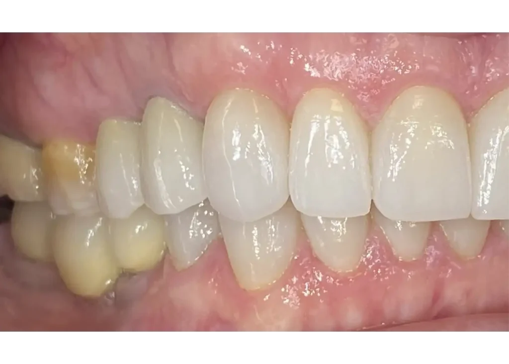 clinica-dental-patricia-aneiros-carillas-casos-despues-lateral-97