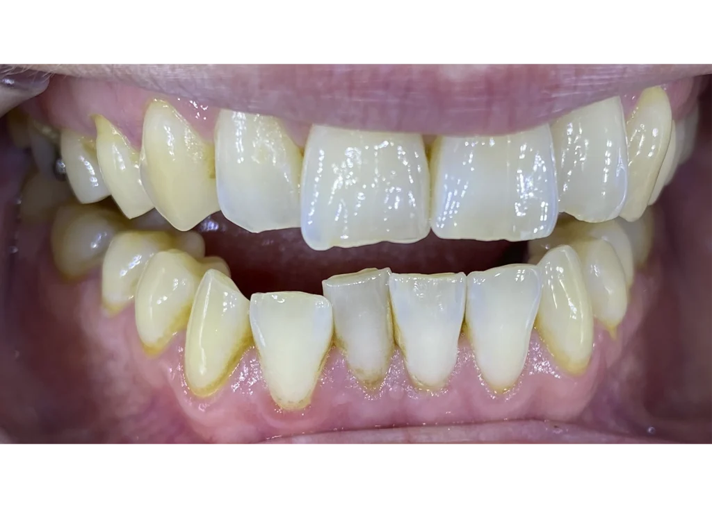 clinica-dental-patricia-aneiros-ortodoncia-casos-antes-96