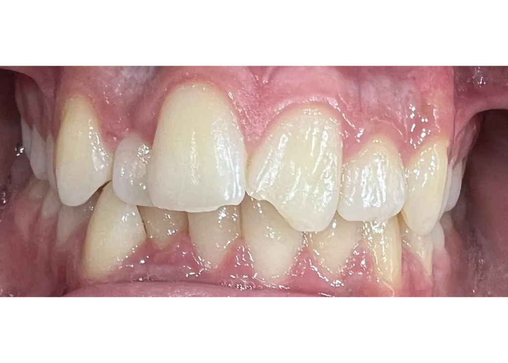 clinica-dental-patricia-aneiros-ortodoncia-casos-antes-98