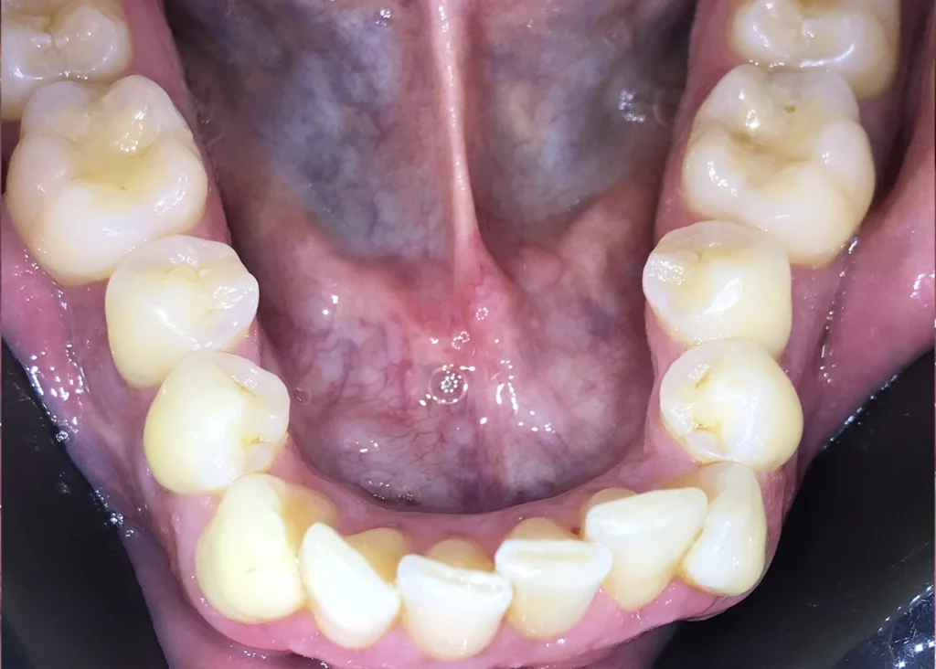 clinica-dental-patricia-aneiros-ortodoncia-casos-antes-99
