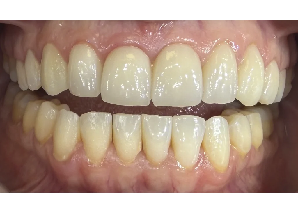 clinica-dental-patricia-aneiros-ortodoncia-casos-despues-96