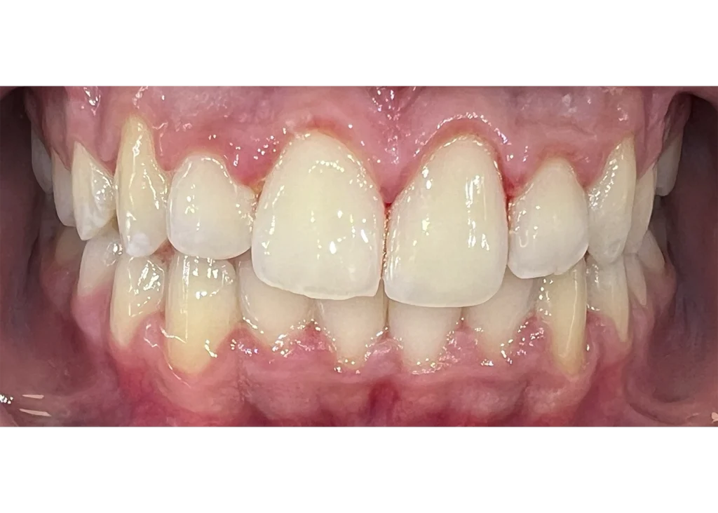 clinica-dental-patricia-aneiros-ortodoncia-casos-despues-98