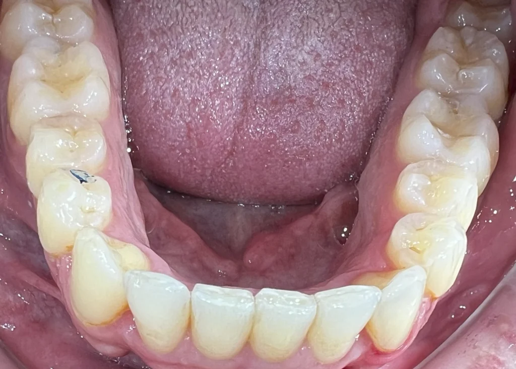 clinica-dental-patricia-aneiros-ortodoncia-casos-despues-99