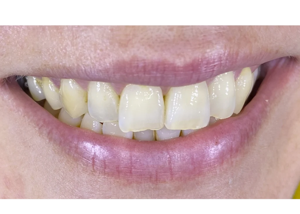 clinica-dental-patricia-aneiros-ortodoncia-casos-sonrisa-antes-96