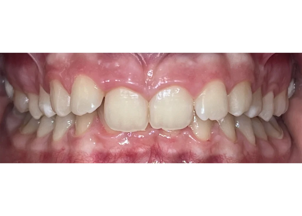 clinica-dental-patricia-aneiros-ortodoncia-casos-sonrisa-antes-97