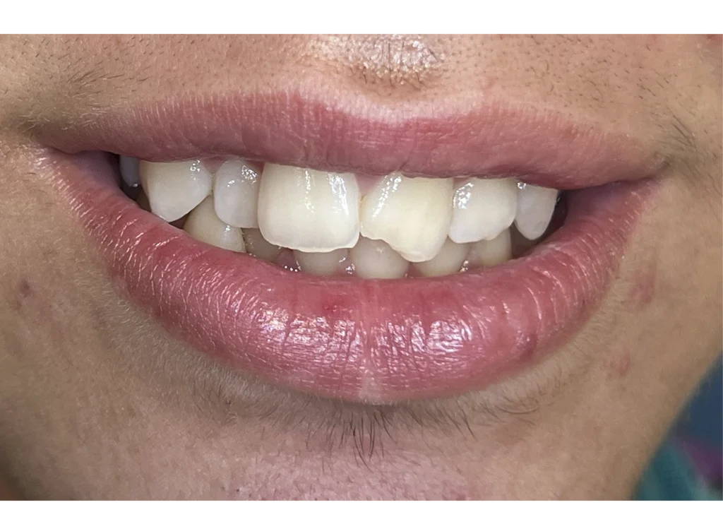 clinica-dental-patricia-aneiros-ortodoncia-casos-sonrisa-antes-98