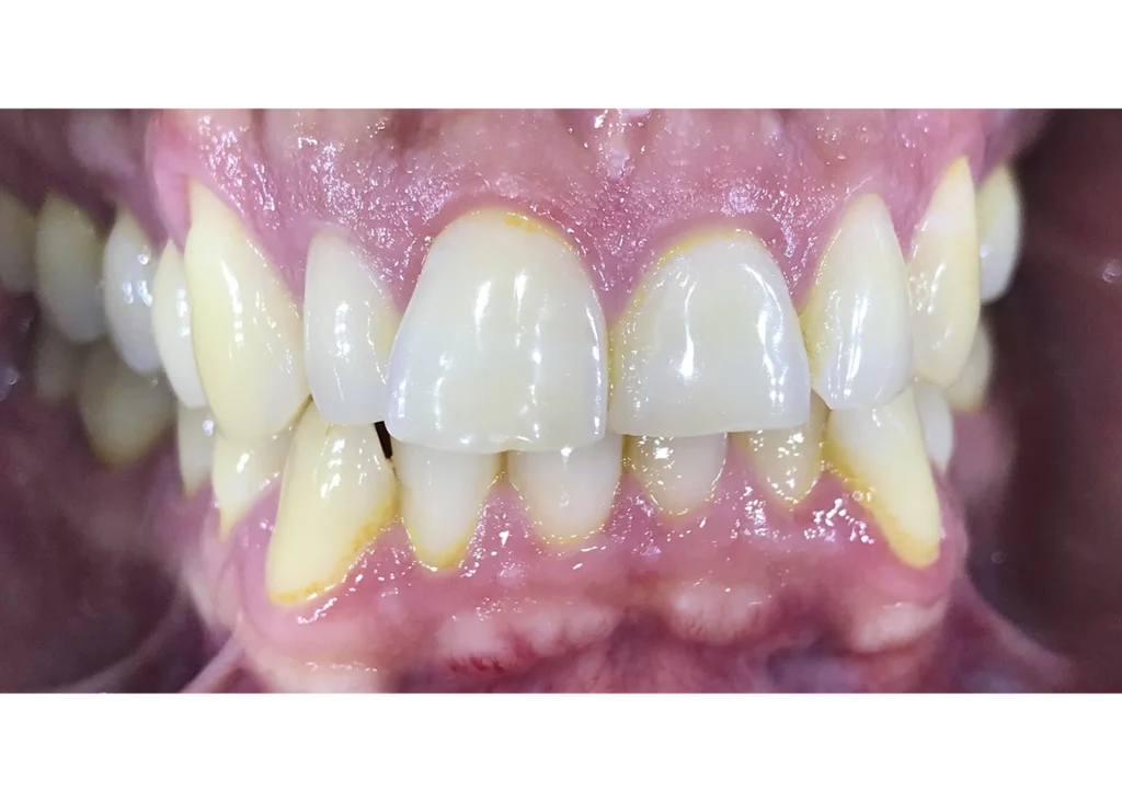 clinica-dental-patricia-aneiros-ortodoncia-casos-sonrisa-antes-99