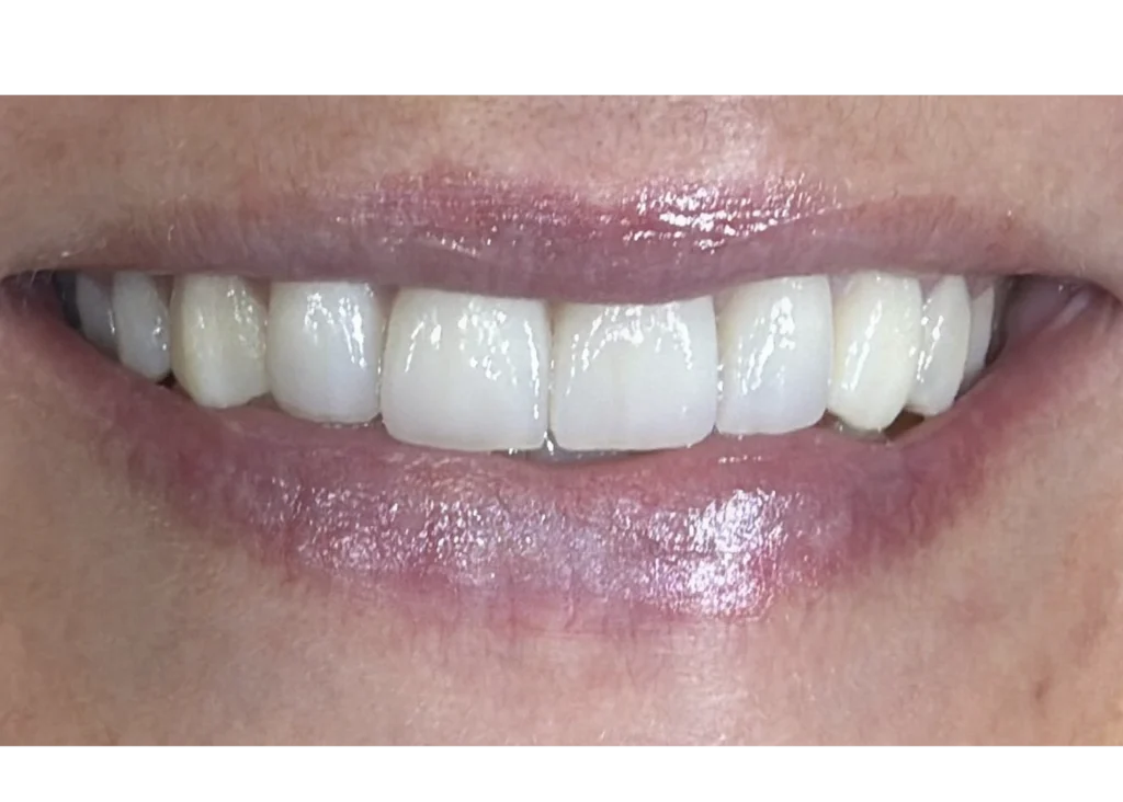 clinica-dental-patricia-aneiros-ortodoncia-casos-sonrisa-despues-96
