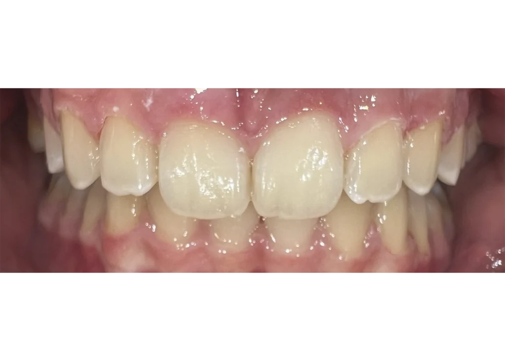 clinica-dental-patricia-aneiros-ortodoncia-casos-sonrisa-despues-97