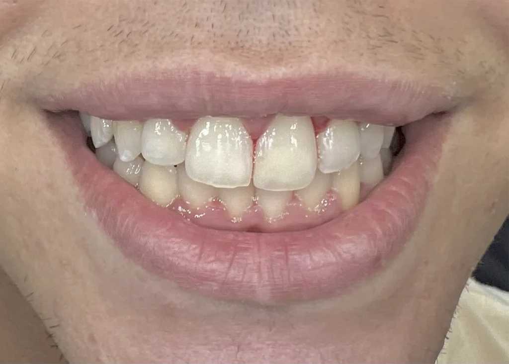 clinica-dental-patricia-aneiros-ortodoncia-casos-sonrisa-despues-98