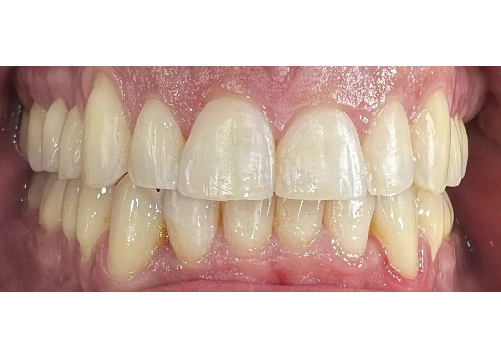 clinica-dental-patricia-aneiros-ortodoncia-casos-sonrisa-despues-99